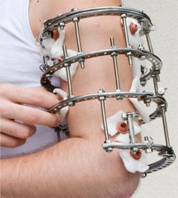 Der Fixateur externe: ein Haltesystem aus Metallstäben, das außerhalb des Körpers mit Schrauben am gebrochenen Knochen befestigt wird.